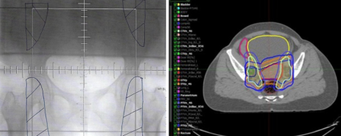 Examples of 2D vs. 3D radiotherapy treatment fields