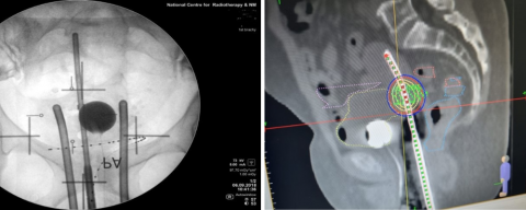 Examples of 2D vs. 3D radiotherapy treatment fields